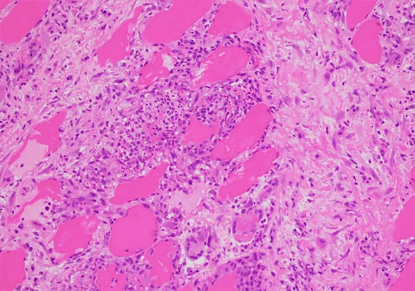 【南宫28助力】治疗结节病的KBMAB-16获FDA批准临床